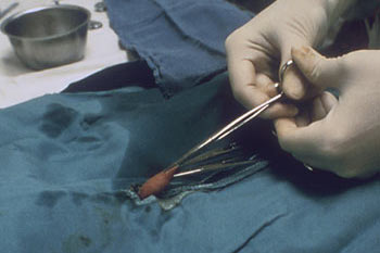 Circumcision trauma