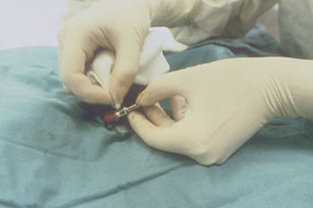 Circumcision trauma